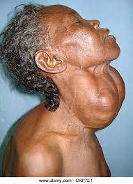 Adamsapfel — adamsapfel, lateinisch prominentia laryngea1, bezeichnet den vor allem bei männern hervorspringenden und tastbaren abschnitt des schildknorpels (cartilago thyroidea) des kehlkopfs. Patient Hat Ein Multinodularem Kropf Eine Schwellung Im Hals Knapp Unterhalb Der Adams Apfel Kehlkopf Durch Eine Vergrosserte Schilddruse Stockfotografie Alamy
