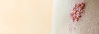 Cât timp persistă durerile în urma herpesului zoster? Zona Zoster O Afectiune Cu Riscuri Pe Termen Lung Cauze Tratament Prevenire Medlife