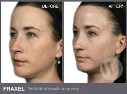 Check spelling or type a new query. Fraxel Skin Rejuvenation Washington Institute