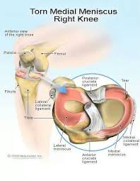Torn Meniscus Meniscus Surgery Meniscus Tear Knee Surgery