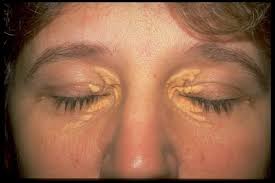 Image result for xantelasma
