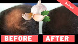 Oral cyclosporine for the treatment of alopecia areata. Does Garlic Help Hair Loss 3 Month Experiment Hairguard