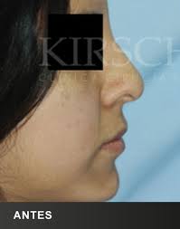 Rinoplastía antes y después