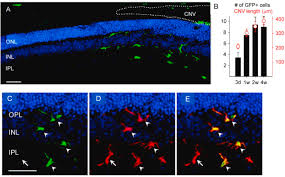 Black and white kitchen table nonexudative amd ryzen master. Incomplete Response To Anti Vegf Therapy In Neovascular Amd Exploring Disease Mechanisms And Therapeutic Opportunities Sciencedirect
