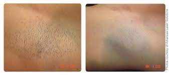 Milan laser hair removal akron, oh. Laser Hair Removal Novus Clinic Akron Cleveland