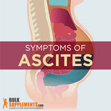 Image result for Ascites