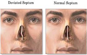 The doctor would likely use a small nasal telescope that removes nasal polyps. Deviated Nasal Septum Treatment Septoplasty Surgery Cost Venkat Center For Skin Plastic Surgery