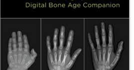Quest For Health What Is A Bone Age