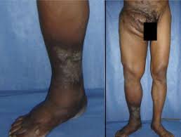 Medical definition of madura foot. Mycetoma Dermnet Nz