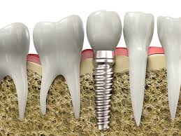 Bone loss caused by periodontal disease results in osseous defects. Jawbone Regeneration For Dental Implants