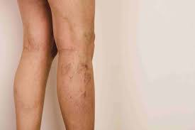 Image result for Pigment stains on the shin
