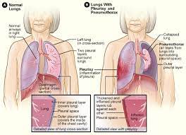 Pleurisy Wikipedia