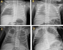 Image result for Atelectasis