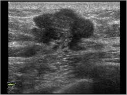Types vary based on the location of cancer cells and what they look like. Breast And Axilla 5 8 Male Breast Case 5 8 2 Malignant Breast Tumors In Male Patients Ultrasound Cases
