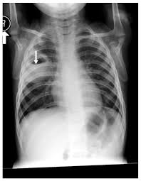 Image result for Lung Abscess