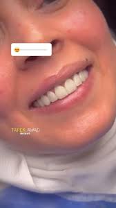 Emax veneers & crowns, ##smile #teeth #cosmetics #dental #dentalcrowns  #hollywdentalphotographgroodsmile #dentalcases #dentalcases ##dentalcate  #lthiumdisilicate