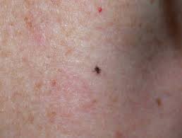 The rete ridges are elongated and increased numbers of melanocytes are present as nests at the tips of the rete ridges and single cells distributed along the. Lentigo Images Dermnet Nz