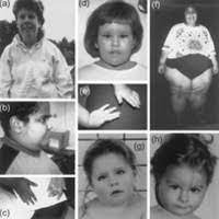 Read more about symptoms, diagnosis, treatment. Sindrom Prader Willi Kelainan Genetis Yang Langka