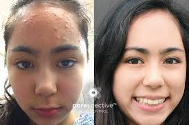 Lisa's Journey to Clear Skin with POREspective