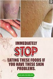 Gluten Is A Rich Source Of Protein Which Can Be Provided Through Foods Containing I Gluten Allergies Symptoms Gluten Intolerance Symptoms Food Allergy Symptoms