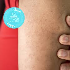 Image result for Keratosis pilaris