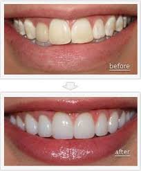 15 Best Dental Veneers Images Dental Veneers Dental