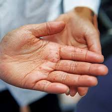 Image result for scabies on humans