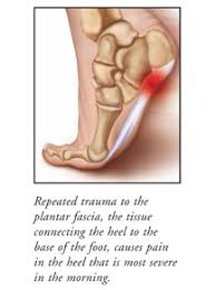 Plantar Fasciitis