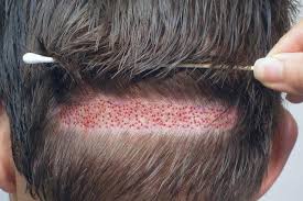 زراعة الشعر في السعودية دليلك الشامل مجلة أخبار الشعب