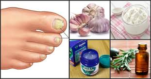 Hay varios medicamentos recetados, así como de venta libre contra los hongos, que pueden ayudar a deshacerse del hongo del dedo del pie. Como Eliminar Los Hongos De Las Unas Bioguia