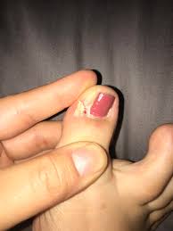 However, if you keep up the routine of rubbing treatment on your nail and practice proper nail hygiene, the nail fungus will soon go away. Had My Ingrown Toenails Removed By A Podiatrist Years Ago And One Still Grows Back Every Month Or So I Pry This Shard Out Of The Corner And The Relief Is Incredible