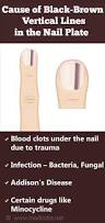 Image result for Acral lentiginous melanoma nail