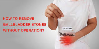 While most doctors recommend removal of the gallbladder to treat gallstones, gallstones can be treated naturally at home at a fraction of the cost. How To Remove Gallbladder Stones Without Operation