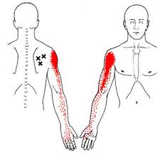 Deformity to the shoulder joint. Referred Pain Pattern Red From Infraspinatus Muscle Mtrp Download Scientific Diagram