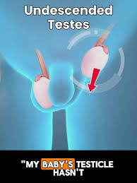 Image result for Undescended Testicle