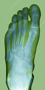 Image result for Foot XRay
