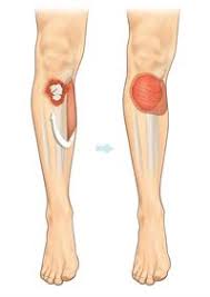 Image result for Open Fracture