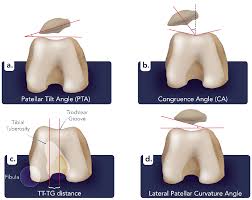 Image result for Patellar Tilt Test
