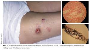 Image result for Panniculitis