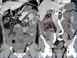 Ct scans are most often an outpatient procedure. The Radiology Assistant Ct Contrast Injection And Protocols