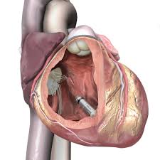 A pacemaker is indicated when electrical impulse conduction or formation is dangerously disturbed. Nye Studier Bekrefter Fordeler Ved Verdens Minste Pacemaker Medtronic
