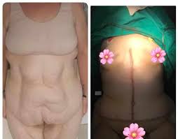 Details of a tummy tuck procedure; Before After Fleur De Lis Surgery Leg Lift Getsliminturkey Gmail Com Fluer Fluerdelis Fluerdelistummytuck Tummytuck Plasticsurgery Surgery Surgeryabroad Izmir Turkey Dublin Ireland Flattummy Get Slim In Turkey Obesity Plastic