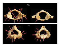 In fact, the articular facets of the atlas align perfectly with the occipital condyles on the skull. Human Cervical Vertebrae Atlas Axis