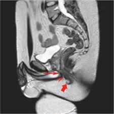 Mri of the soft tissues of the foot visualizes the fat cushions of the sole, heels, fingers and can show. Mri Anatomy Of The Anorectal Region Springerlink