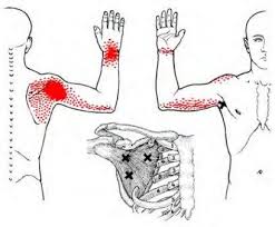 Subscapularis Trigger Point Map Trigger Points Trigger Point Therapy Subscapularis Muscle