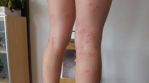 En dehors de ces les troubles érectiles chez l'homme peuvent, comme pour l'éjaculation précoce, être dus à une période de stress, de fatigue ou de préoccupations diverses. Invasion Les Aoutats Petits Acariens Voraces Adorent L Idee D Un Dejeuner Sur L Herbe La Voix Du Nord