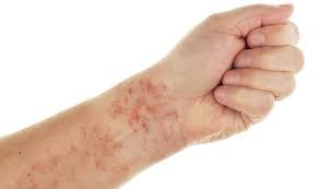 See your child's doctor if they have any of the following symptoms: Blood Cancer Symptoms Petechiae In The Skin Could Be A Sign To Look Out For Express Co Uk