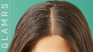 I have had dandruff for a long time but my hair fall started about four months back. How To Get Rid Of Dandruff The Ultimate Hair Care Routine For Dandruff And Itchy Scalp Youtube