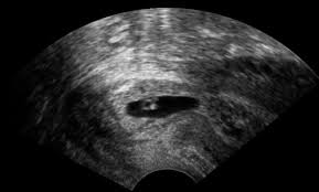 The cervix during pregnancy needs to be thick to keep the uterus protected, but will start thinning in preparation for delivery. Cervical Pregnancy Wikipedia