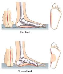 Pin On Flat Feet Remedies Arch Building Exercises